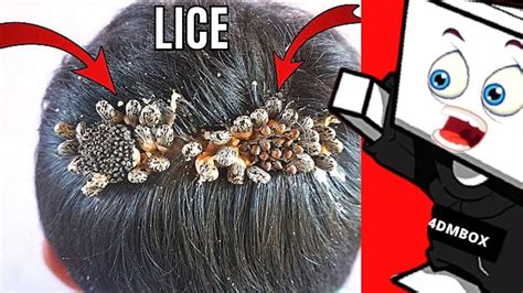 Worst Head Lice Infestation Ever Youtube