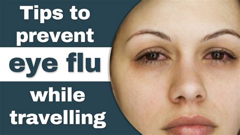 Eye Flu Prevention Tips To Prevent Eye Flu While Traveling Watch Video