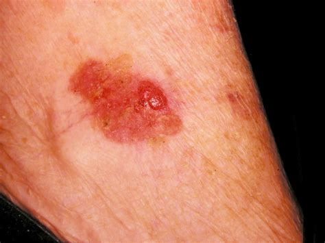 Managing Non Melanoma Skin Cancer In Primary Care A Focus On Topical