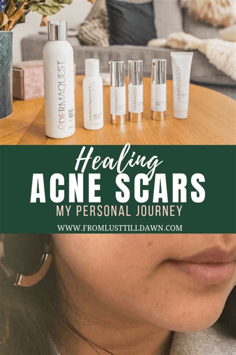 Healing Acne Scars My Personal Journey Sarah Chetrits Lust Till Dawn
