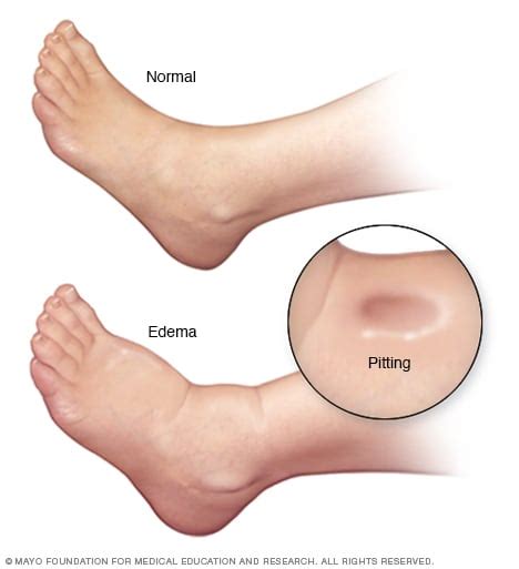 Edema Swelling Of Feet And Legs Dr Segals Canada