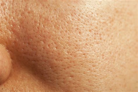 Large Pores Symptoms And Causes Skin Institute