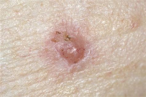 Basal Cell Carcinoma Skin Cancer Stock Image C Science Photo Library