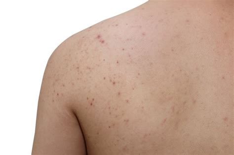 Causes Of Acne On The Arms And Back Livestrongcom