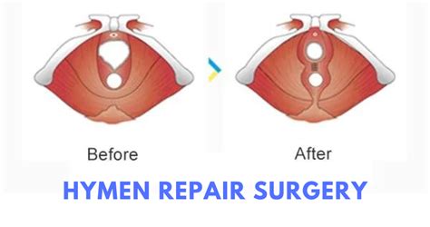 Best Hymen Repair Surgery In India Secure