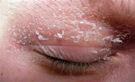 Dry Skin On Eyes Nose Ear Hands Or Legs Remedies Skincarederm