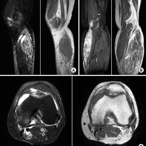 Magnetic Resonance Imaging Of The Left Knee T2 Weighted And