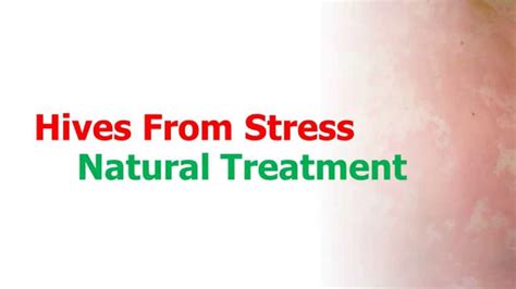 Hives From Stress Natural Treatment Youtube