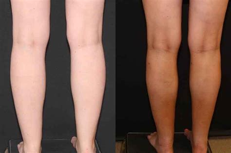 Calf Liposuction Before And After Photos 14 Liposuction Lymphatic