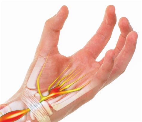 Carpal Tunnel Syndrome Anatomy