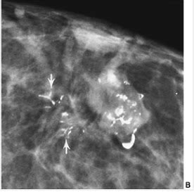 ON RADIOLOGY CALCIFICATIONS In Carcinoma Of The Breast