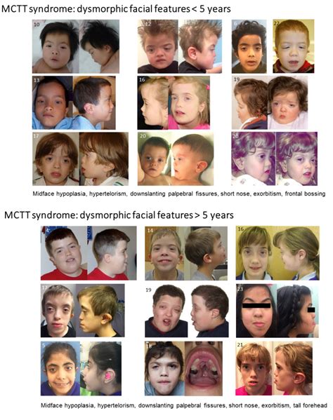 Figure 1 Facial Features Of Individuals With Genereviews