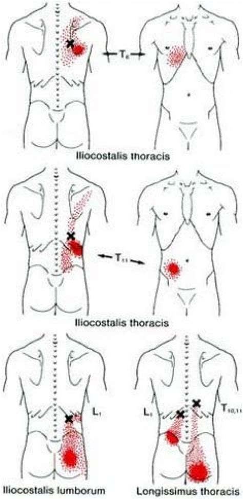 Trigger Point Maps PsoasExercises In Massage Trigger Points Trigger Point Therapy