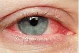 Photos of Should You Go To School With Pink Eye