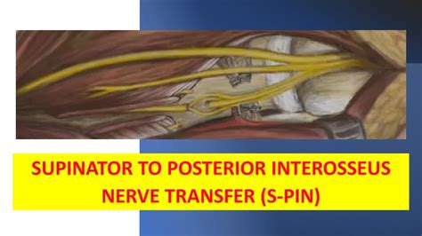 Supinator To Posterior Interosseus Nerve Transfer Spin Youtube