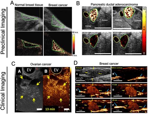 Seeing The InvisibleUltrasound Molecular Imaging Ultrasound In