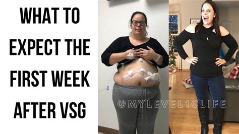 First Week After Vsg What To Expect After Weight Loss Surgery Youtube