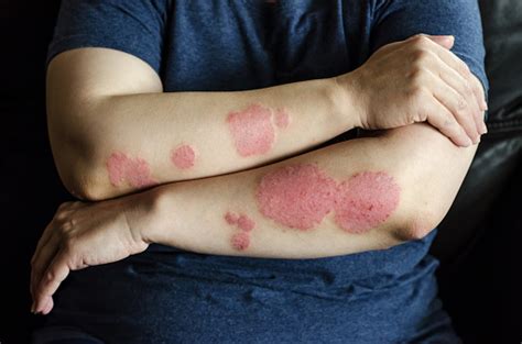 Dermatological Skin Disease Psoriasis Eczema Dermatitis Allergies Skin