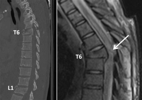 Unstable Spine Injuries At T6 And L1 On Initial Multisl Open I