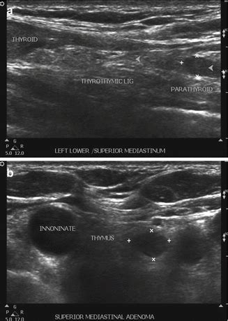 Ultrasonography Of The Parathyroid Glands Radiology Key My Xxx Hot Girl