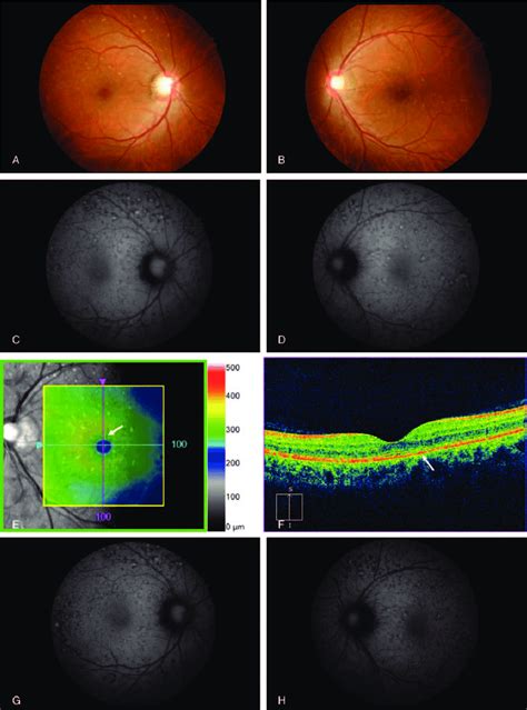 Fundus Findings At 463 Days And 3 Years After Delivery At 463 Days