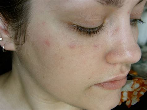 Jan Sever Red Spots On Face With Dry Skin Zits
