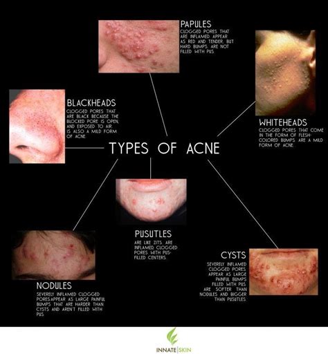 Pimples Varieties Learn How To Acknowledge What Sort Of Pimples You