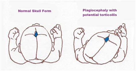 Your Babys Head Is Like Play Doh How Plagiocephaly Occurs Chloé Sardin