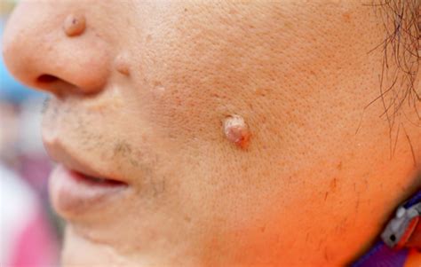 11 Unusual Melanoma Symptoms To Watch Out For Page 7 Of 12