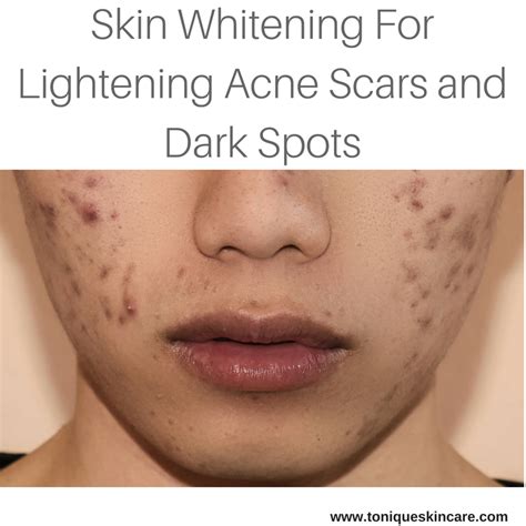 skin whitening for lightening acne scars and dark spots tonique skincare