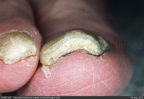 Stock Image Dermatology Onychomycosis Thickened Yellowish White