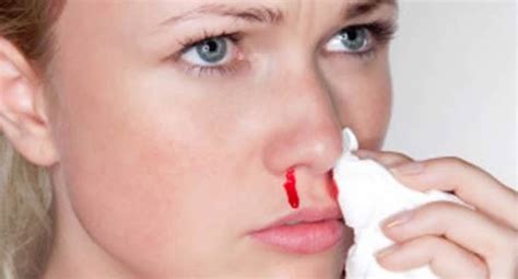 Estas Son Las Causas De La Hemorragia Nasal Y Los Mejores Remedios Para