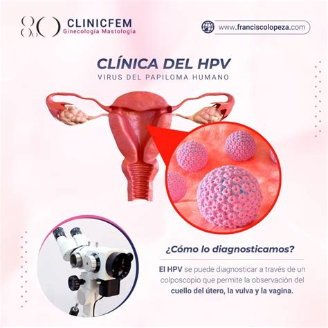Cl Nica Del Vph Y Colposcop A Clinicfem