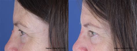 Scar Revision Before And After 06 Weber Facial Plastic Surgery