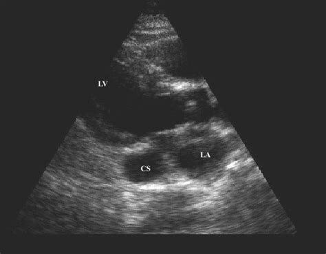 Aivr, accelerated idioventricular rhythm, isorhythmic av dissociation, sinus arrhythmia, idioventricular. Parasternal long axis two-dimensional echocardiographic ...