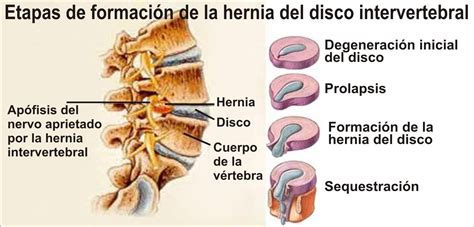 Etapas En La Formación De La Hernia Discal Betis