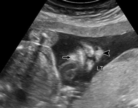 Radiology Of Cleft Lip And Palate Imaging For The Prenatal Period And