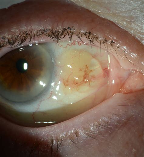 Unveiling Ocular Surface Squamous Neoplasia Within A Conjunctival