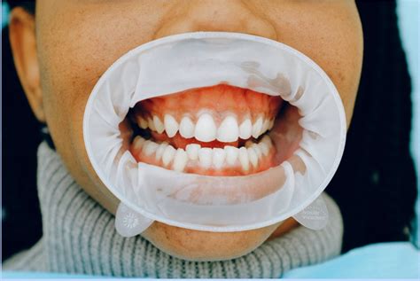 What Does It Mean If You Have White Stuff On Your Gums Patient