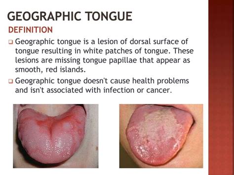 Ppt Tongue Disorders Powerpoint Presentation Id1947046