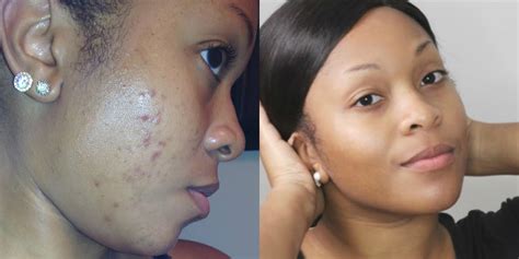 How To Get Rid Of Dark Spots Fade Acne Scars Get Clear Skin Youtube