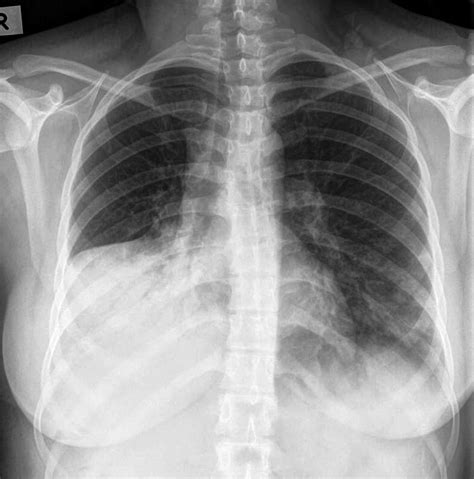 Examples Of Chest X Rays In Chestxray The Normal Viral Pneumonia
