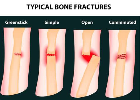 Kinds Of Bone Fractures
