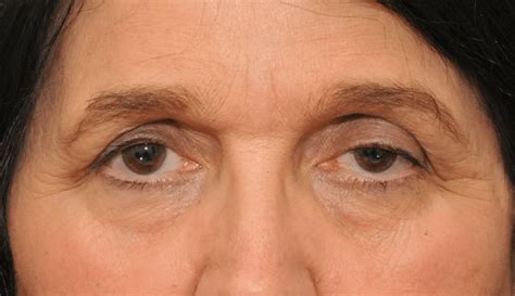 Botox Side Effects Droopy Eyelid