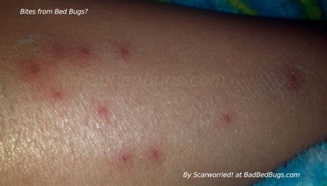 Itchy Bed Bug Bites Discussion 10