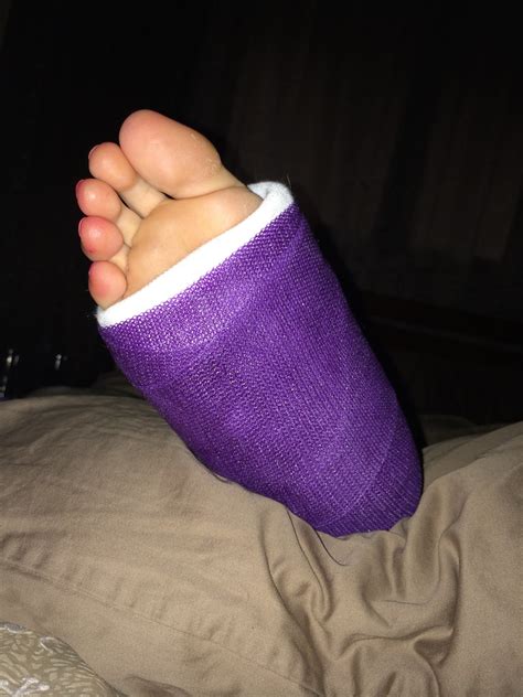 Broken Ankle Purple Cast Pink Toes Sole Cast Foot Fetish Flickr