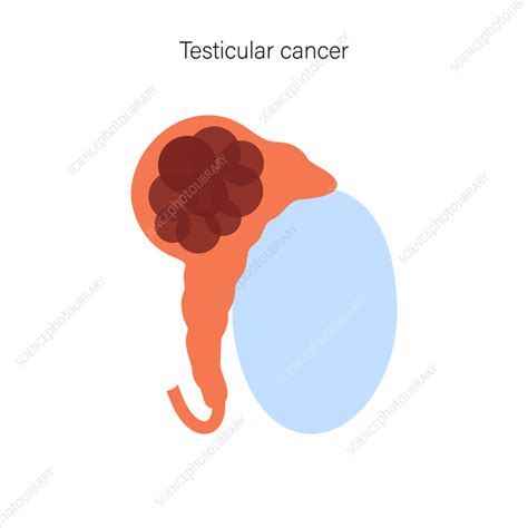 Testicular Cancer Illustration Stock Image F Science Photo Library