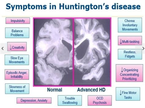 Pin On Information About Huntingtons Disease