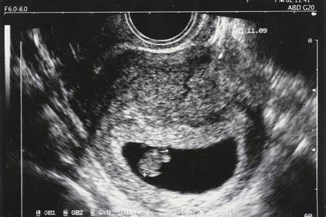 Scan At 7 Weeks Pregnant
