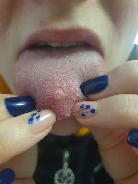 Is My Tongue Piercing Infected Thriftyfun